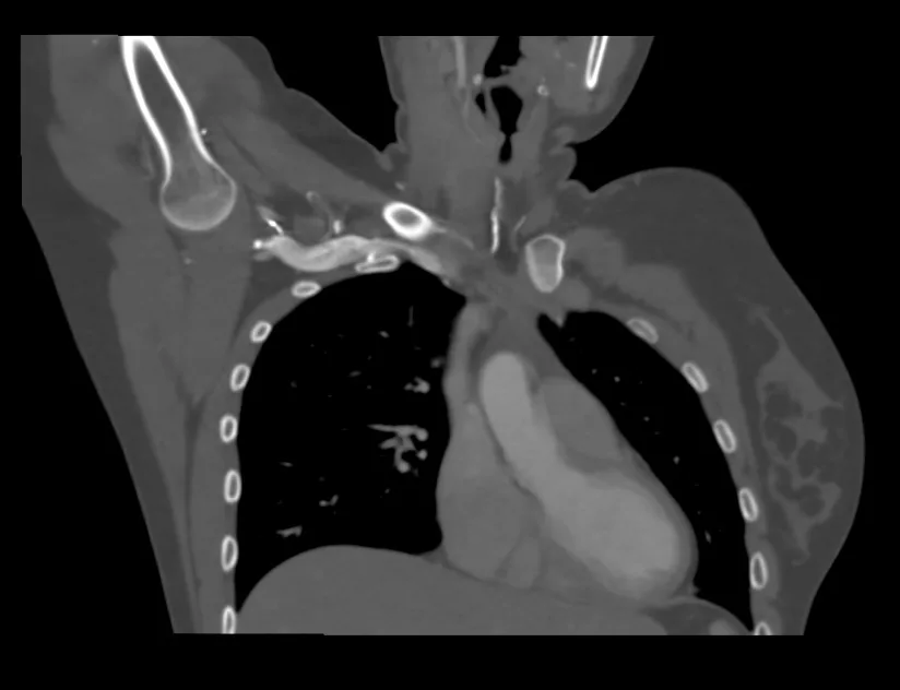 AngioTC de tórax en reconstrucción coronal con el brazo en abducción: arteria subclavia a su paso por el opérculo torácico