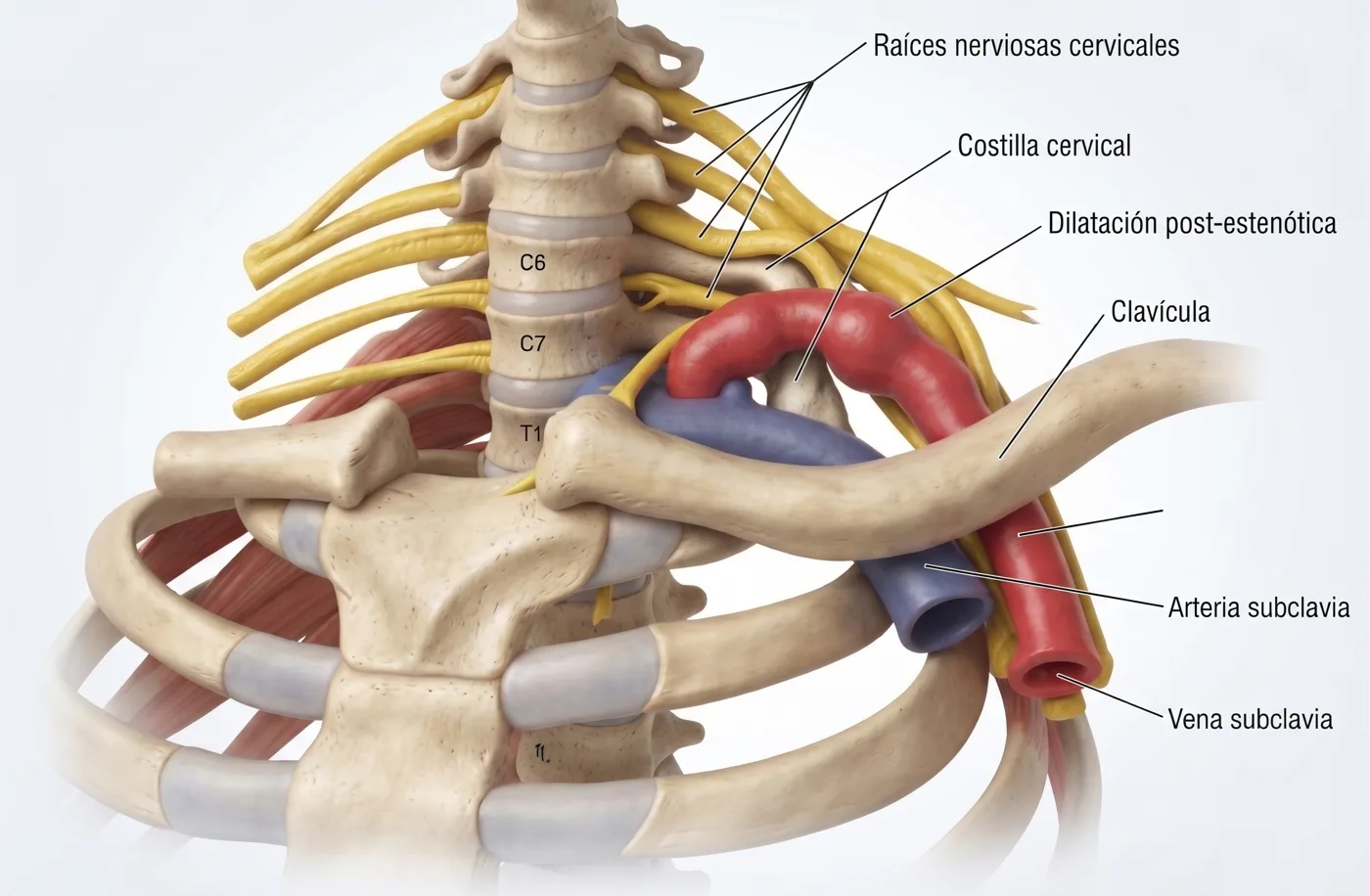 Costilla cervical que comprime la arteria subclavia, con dilatación post-estenótica distal