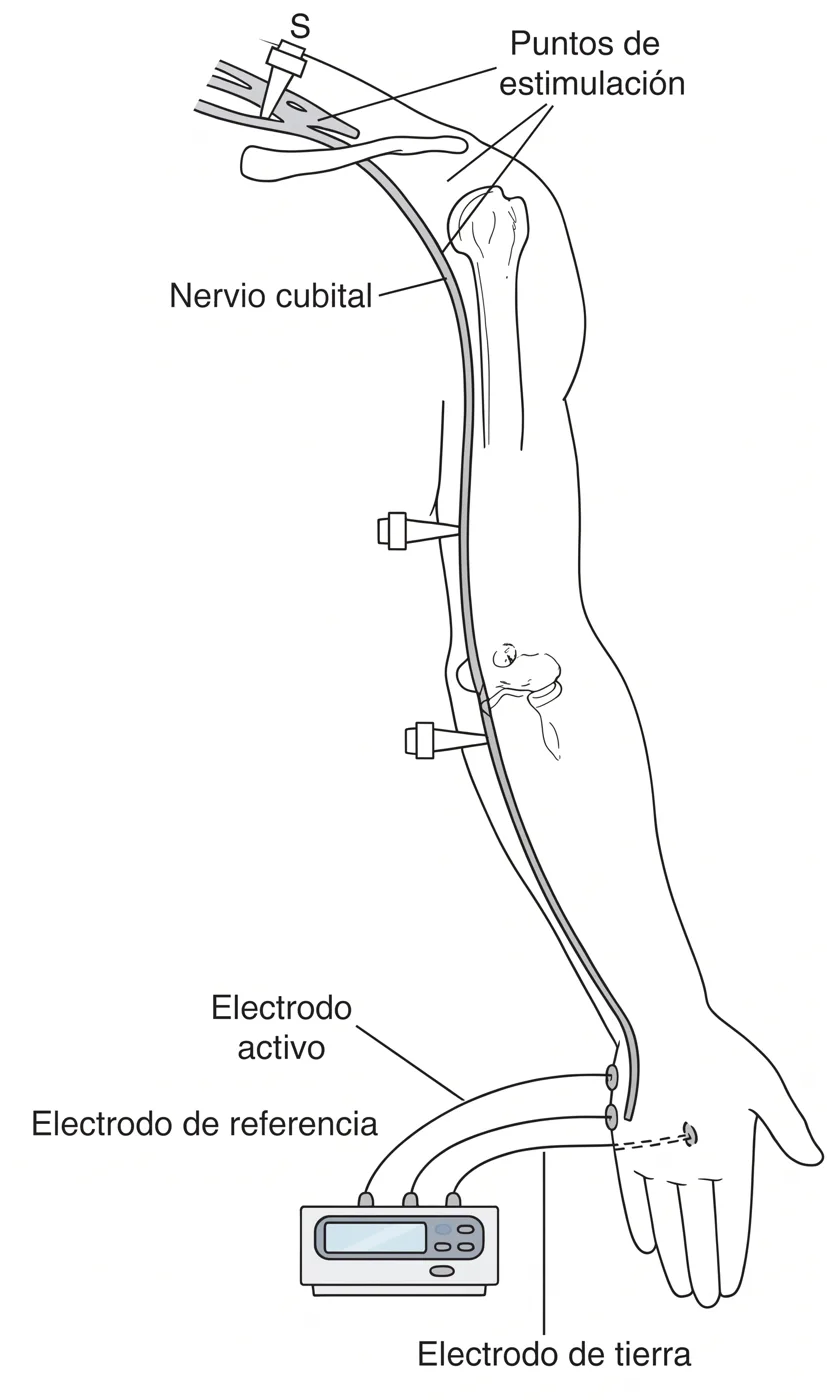 Esquema de estudio de conducción del nervio cubital: puntos de estimulación en plexo, axila, codo y muñeca, con electrodos activo, de referencia y de tierra