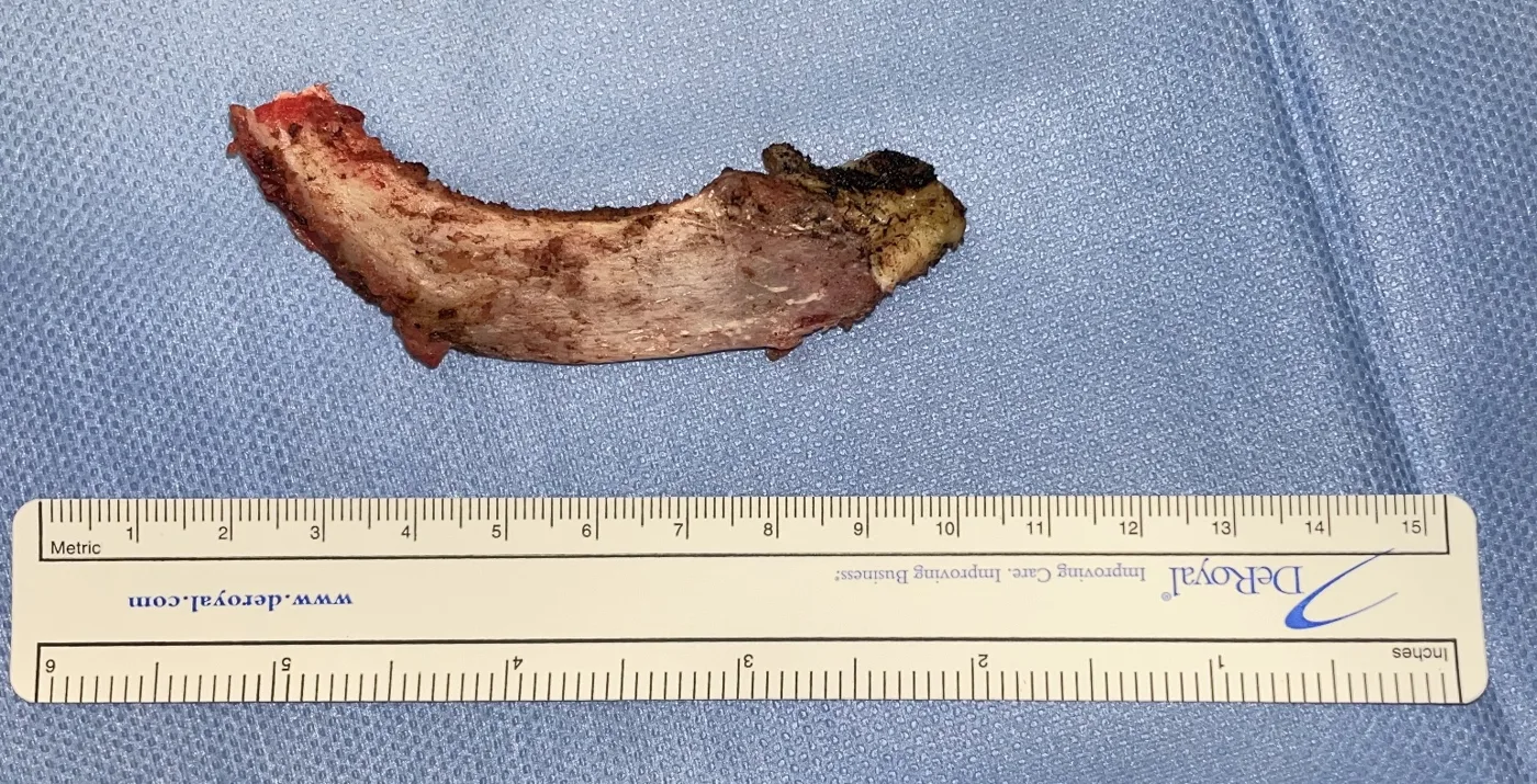 Primera costilla resecada por vía robótica transtorácica, junto a una regla: pieza de unos 12 cm, desde la unión costoesternal hasta cerca de la apófisis transversa