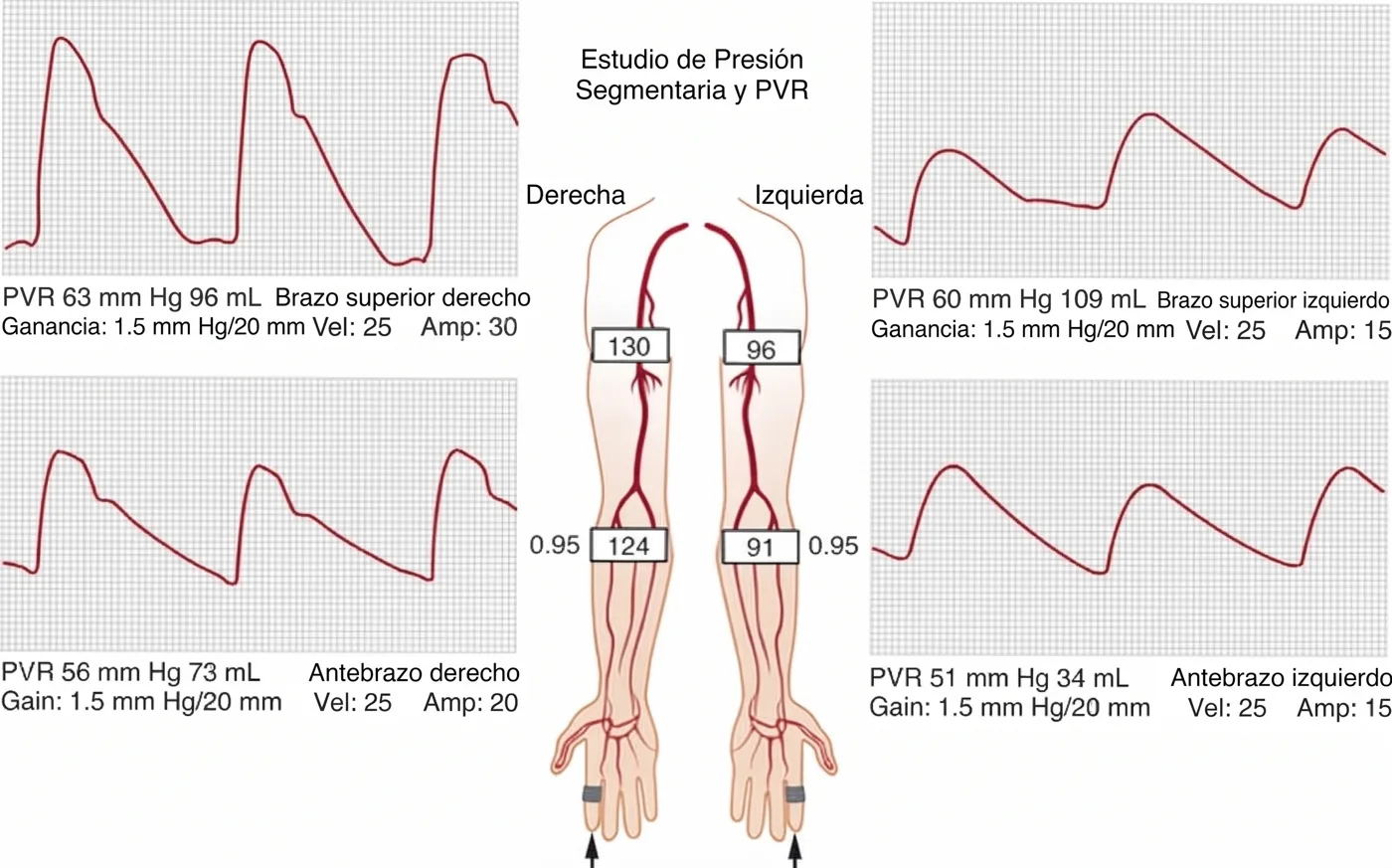 Estudio de presión segmentaria y PVR en ambos brazos: ondas de pulso amortiguadas y presiones menores en el lado izquierdo comprimido