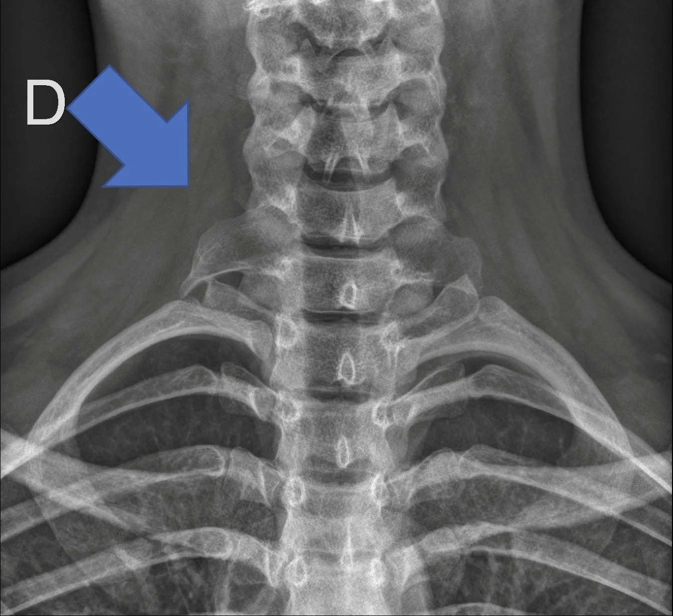 Radiografía de columna cervical y tórax: costilla cervical derecha señalada con flecha