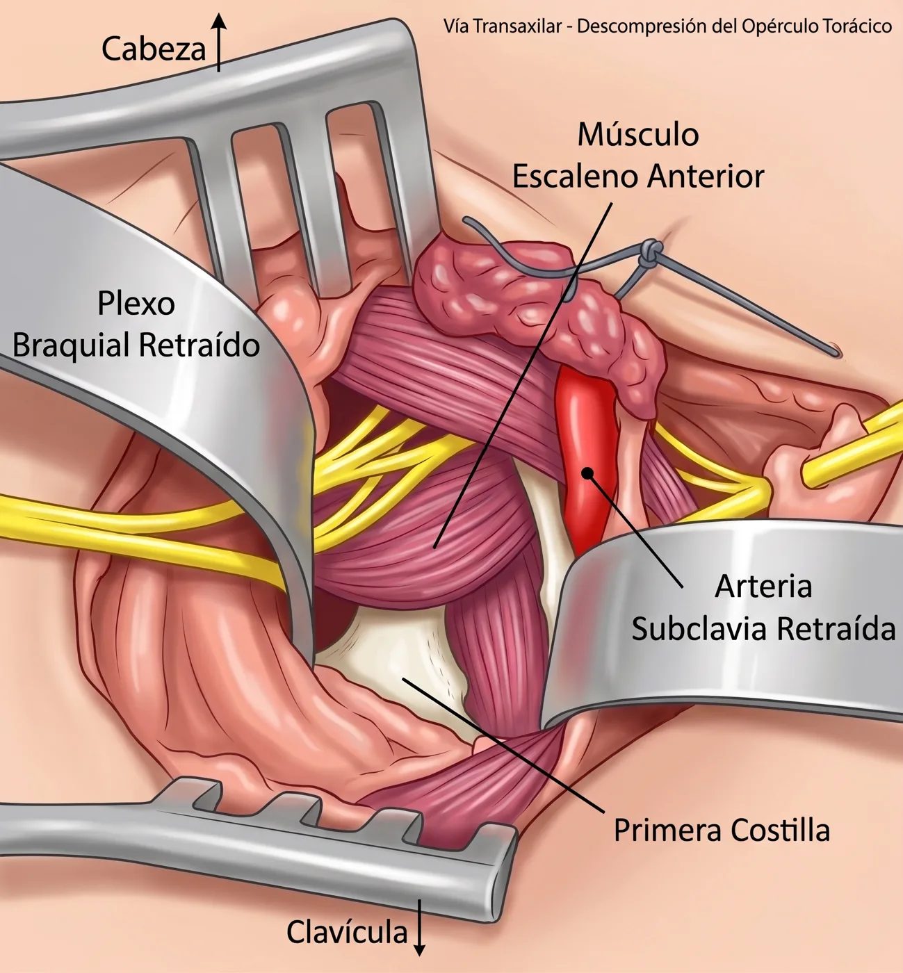 Campo quirúrgico de la vía transaxilar: primera costilla en el fondo, escaleno anterior, y plexo braquial y arteria subclavia retraídos con separadores